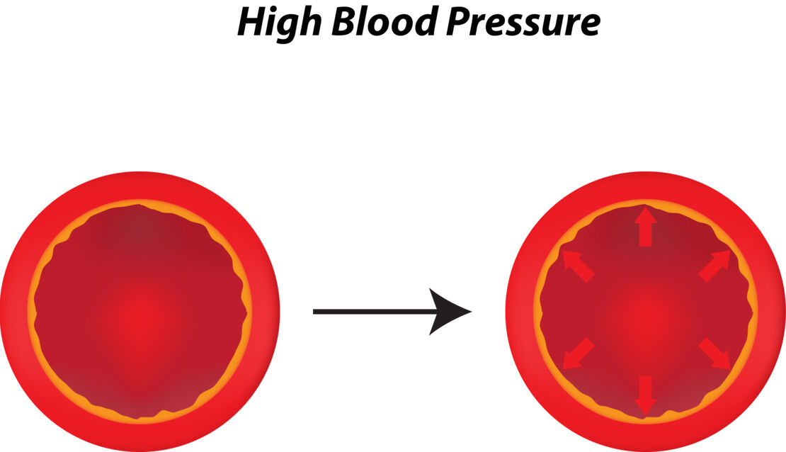Blood pressure_1_AdobeStock_69197080