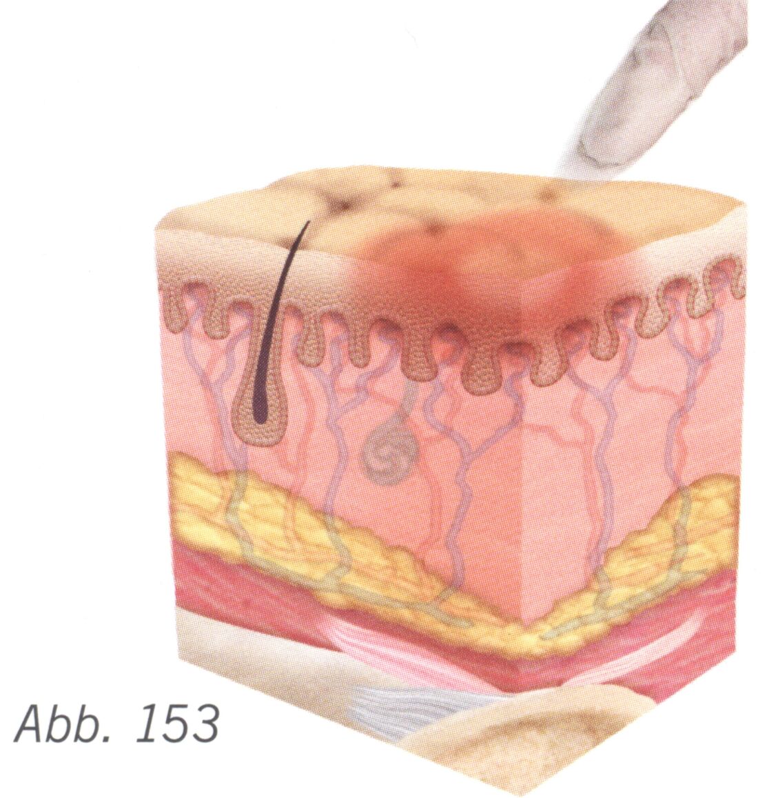 Summary_Decubitus_Picture_34