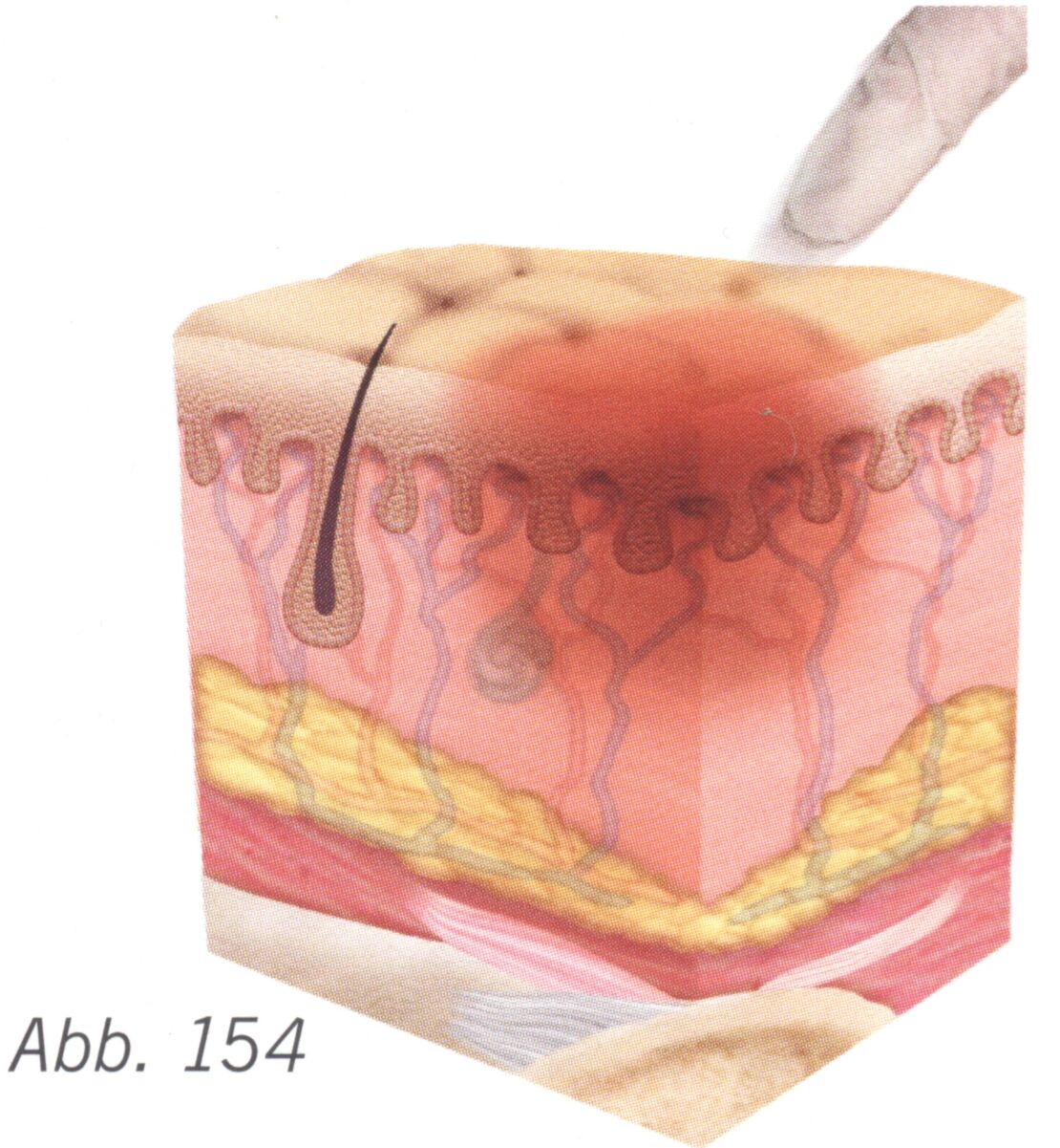 Summary_Decubitus_Picture_35