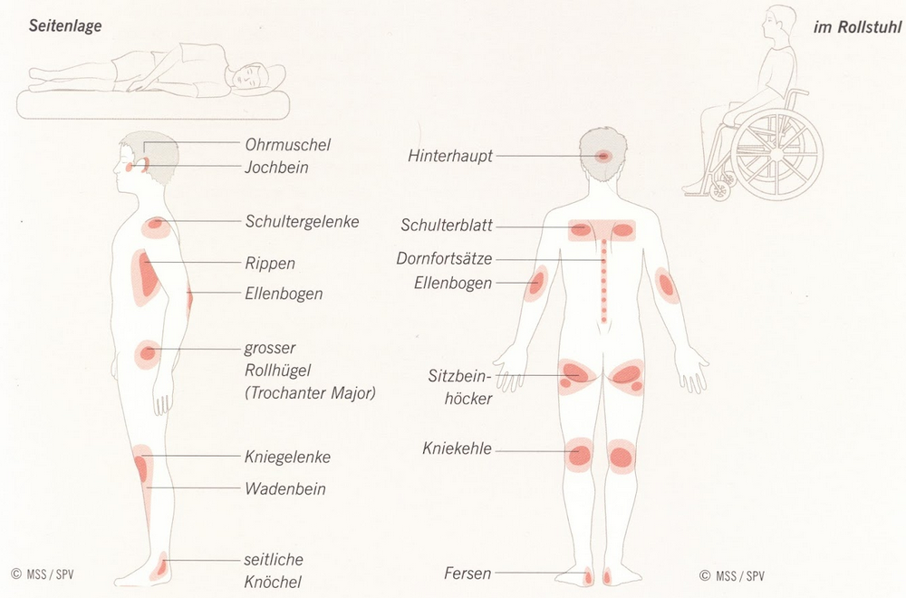 Summary_Decubitus_Picture_31