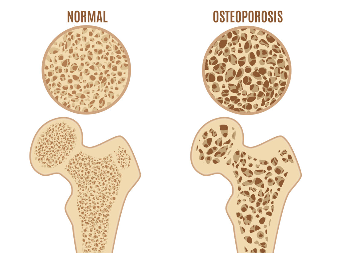 Summary_Bone density_AdobeStock_318879512